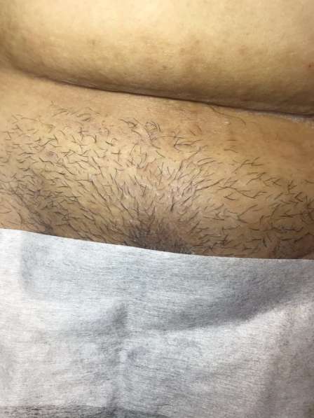 Шугаринг в Ростове-на-Дону фото 3