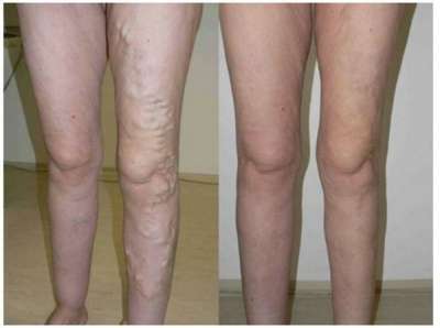 Cream of varicose veins в Санкт-Петербурге