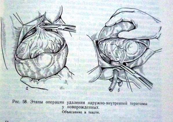 Продам русскую книгу "Хирургия толстой кишки у детей" 1974г в Юрге